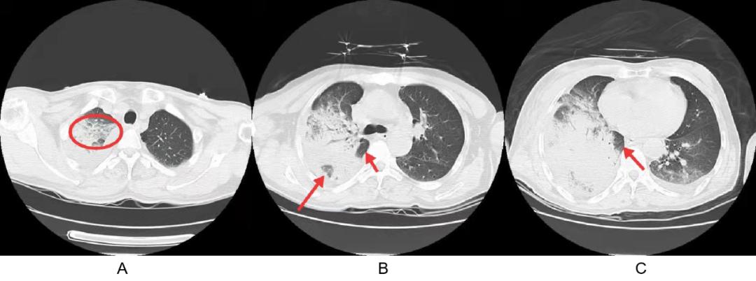 mrsa用什么药,mrsa对哪些药物敏感