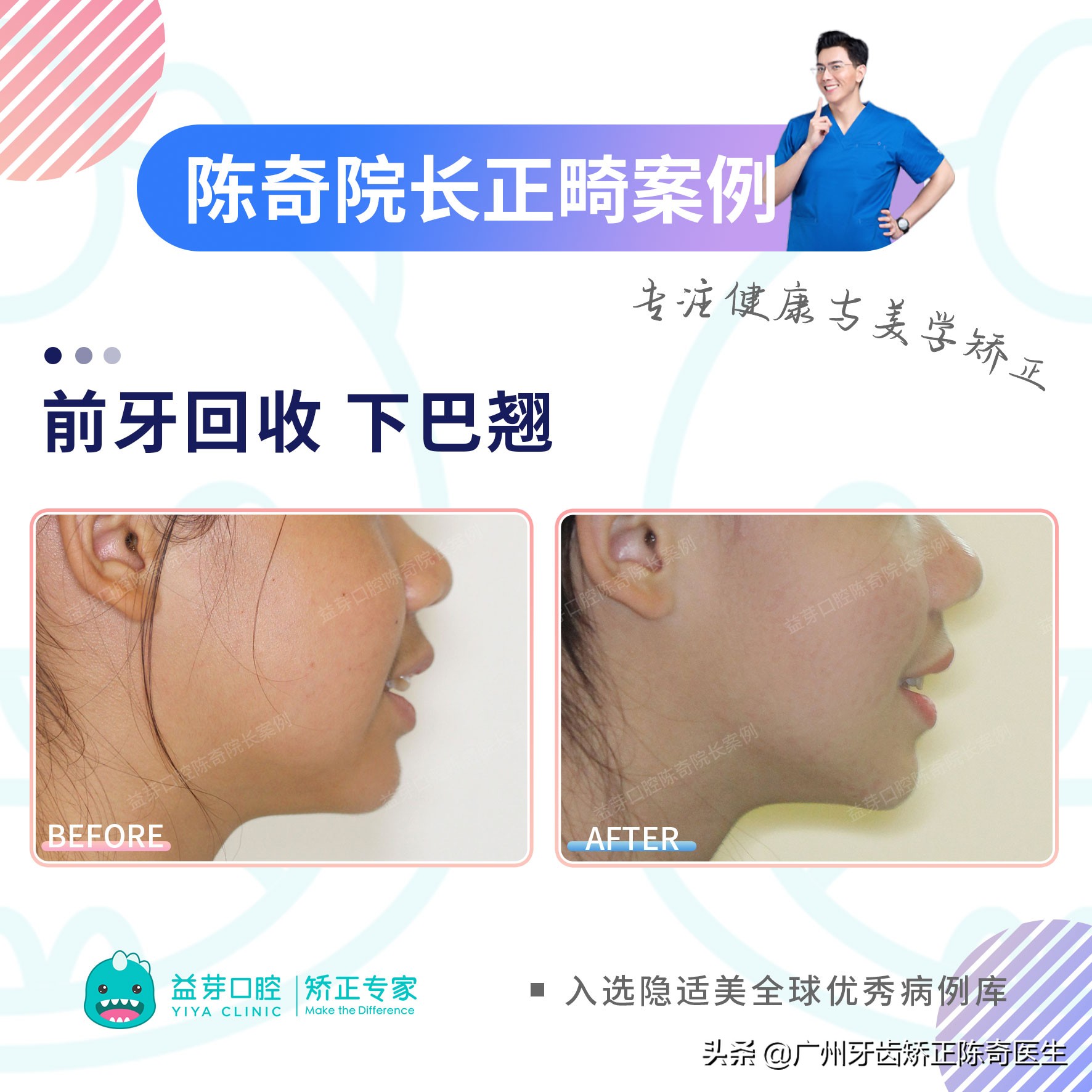 11岁女孩牙齿前突需要扩弓吗,16岁女生上颌骨前突矫正