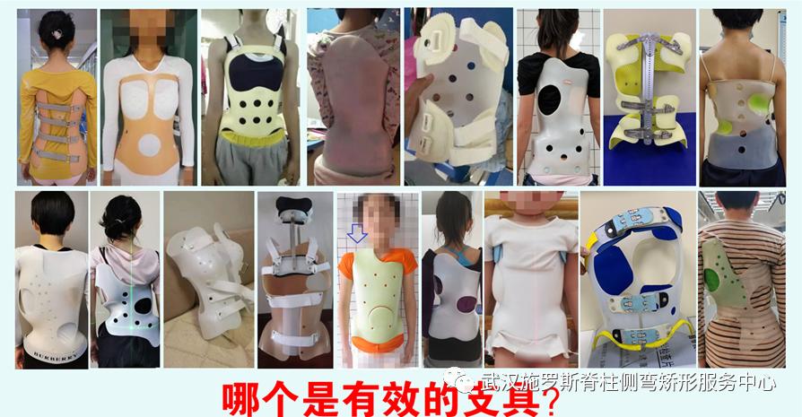 脊柱侧弯矫正支具不调整会怎样,简单辨别脊柱侧弯避免孩子走弯路