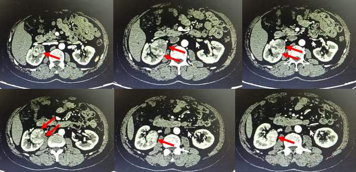 【协和医疗】高难度！泌尿外科朱绍兴教授团队高超“组合拳”完成肾肿瘤保肾手术