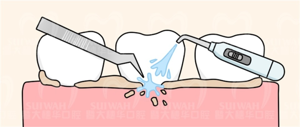 很久没刷牙有牙斑怎么去除,牙齿长了小黑点能靠刷牙解决吗