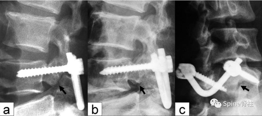 峡部裂和隐性峡部裂有区别吗,单纯峡部裂可以做峡部修复吗