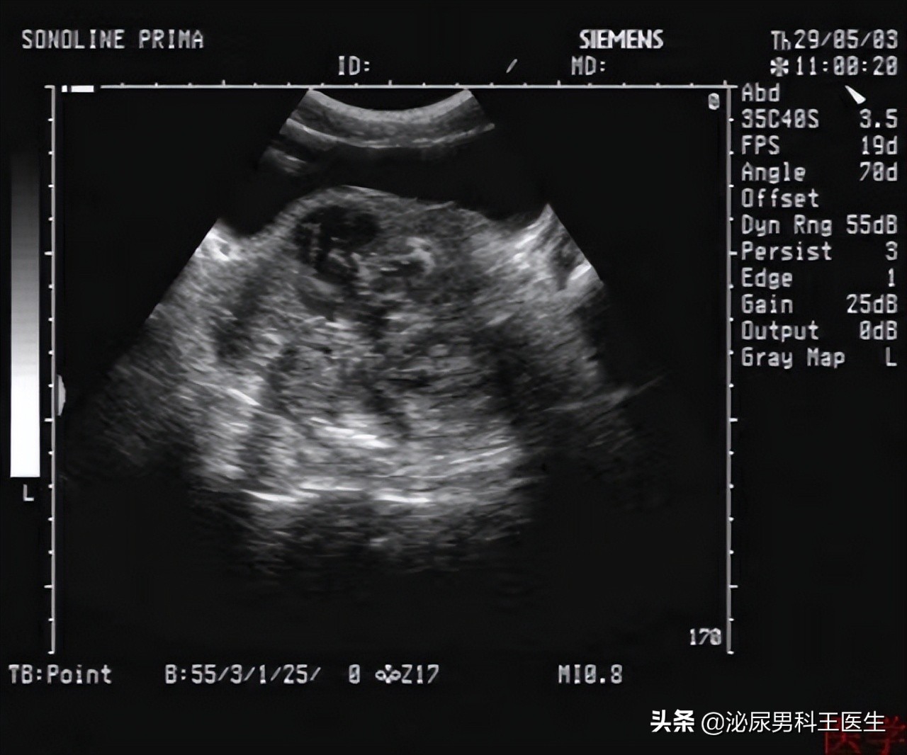 前列腺癌发现就是晚期？叶定伟教授：50岁以上最好每年检查一次