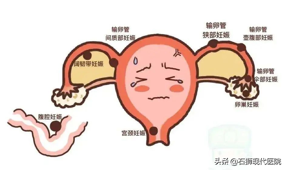 宫外孕危险吗什么症状,宫外孕一般多久会出现危险的症状