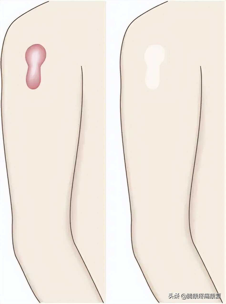 增生性瘢痕和瘢痕疙瘩的鉴别诊断,皮质类固醇贴