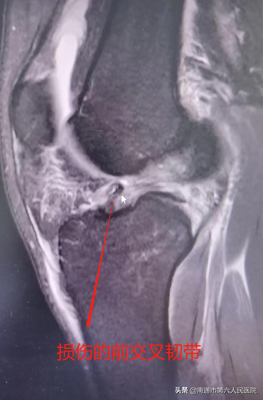 小伙打篮球前十字韧带完全断裂,小伙子打篮球双手断了