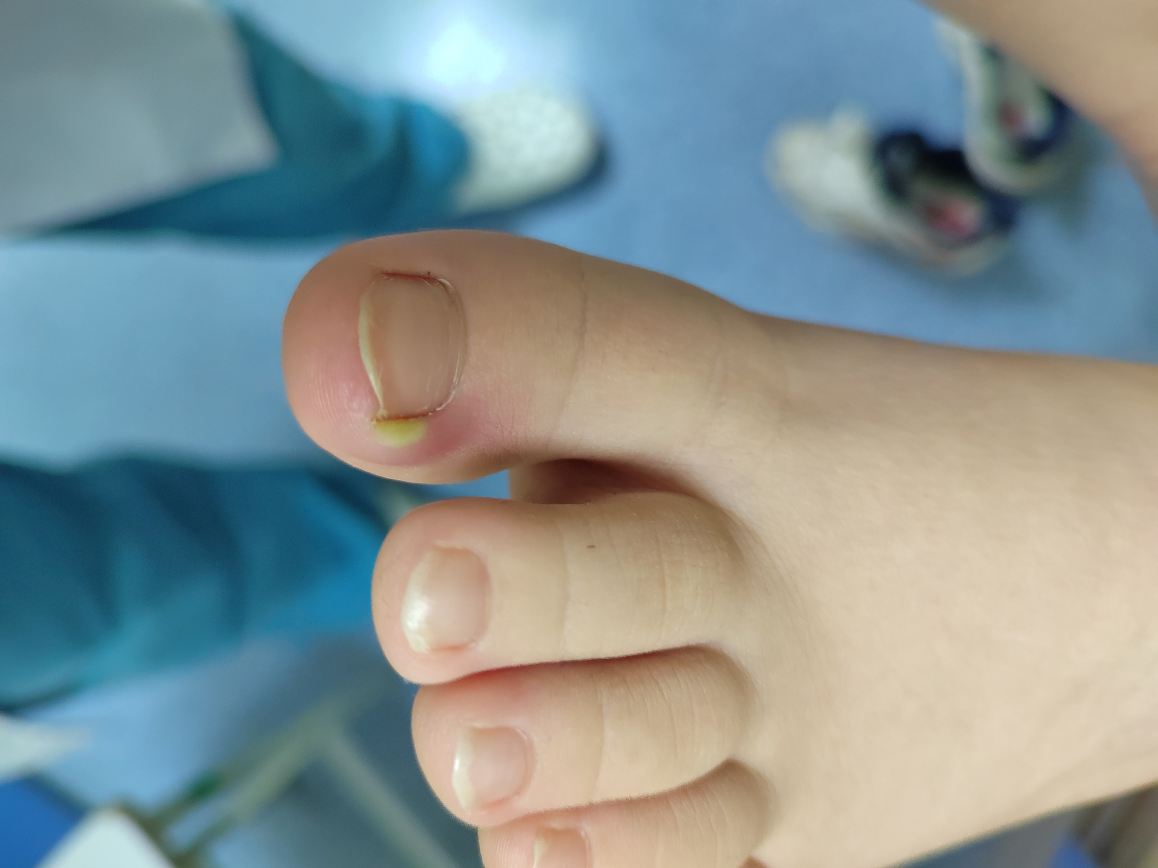 宝宝手指头红肿哭闹,宝宝手指肿胀疼痛是怎么回事