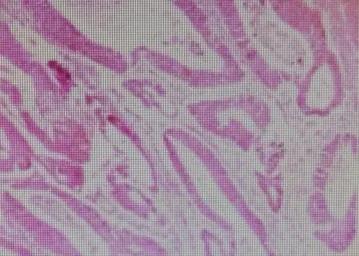 腹腔镜下结肠癌根治术,腹腔镜下结肠癌根治术手术步骤