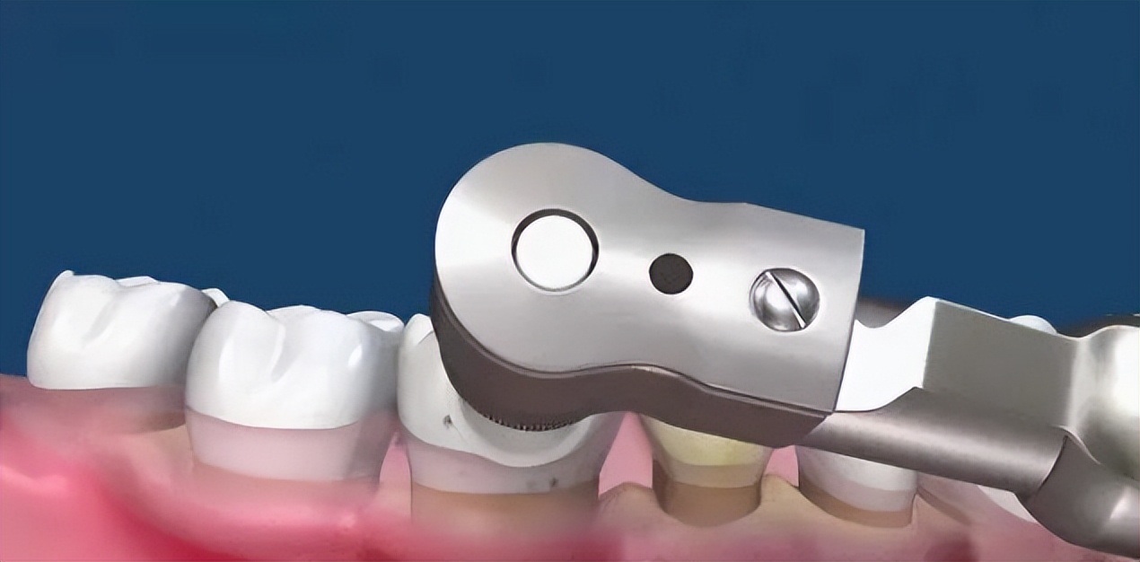 超声波洗牙喷砂和抛光什么意思,赣州洗牙抛光喷砂一起大概多少钱