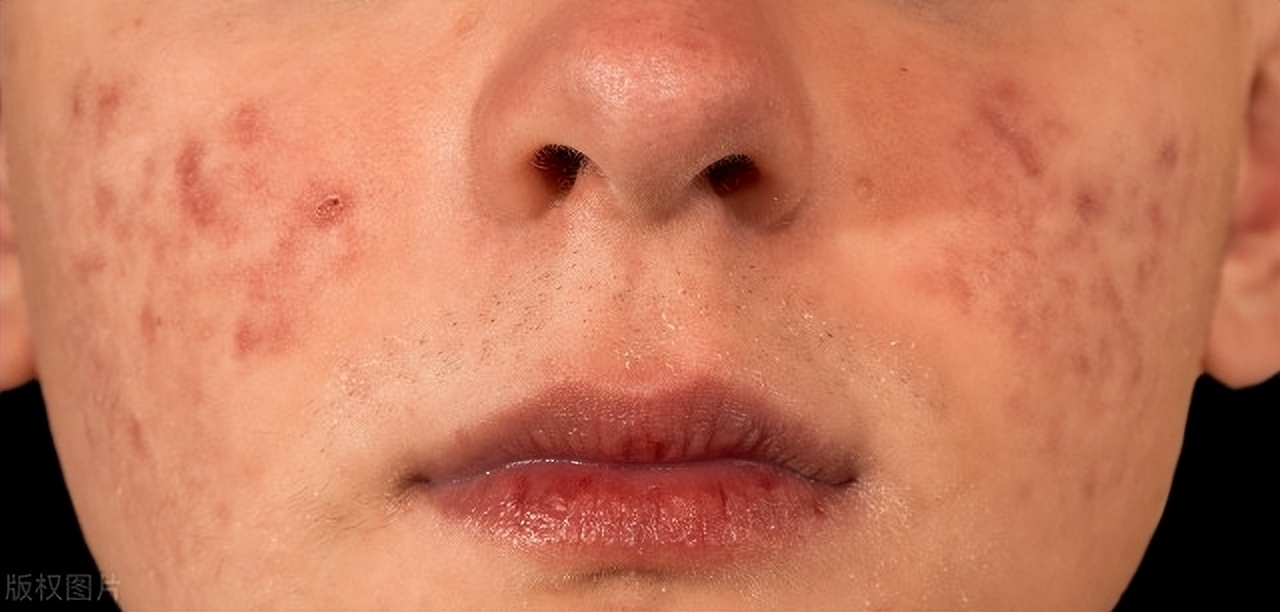 脸上起痘痘跟枕头有关吗,脸上起痘痘和玩手机有关吗