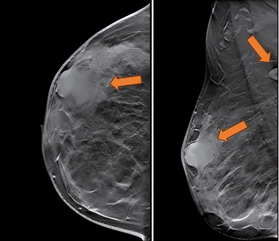 抗her2阳性治疗,双靶向治疗her2复发率