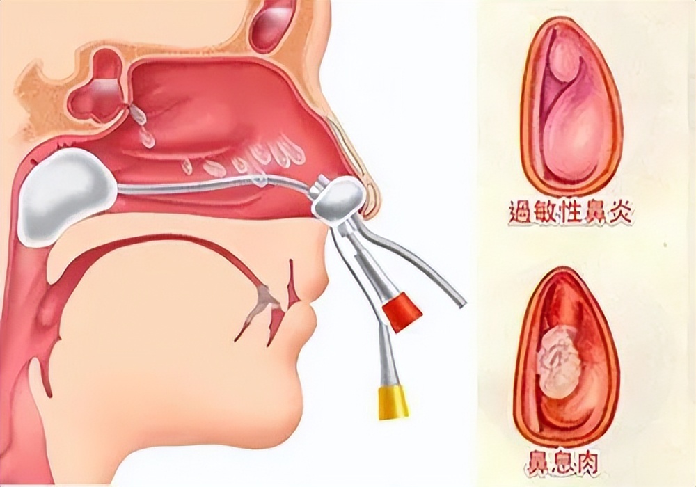 缓解鼻塞流鼻涕的穴位,鼻炎流鼻涕不通气怎么办