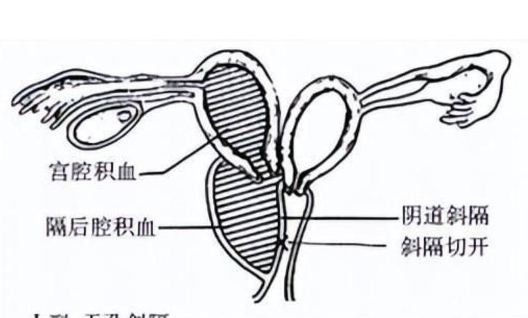 24岁女孩检出两个阴道，还有双子宫？医生解答，详细告诉你怎么办
