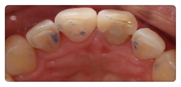 补的牙遇冷热疼怎么办,为什么补了牙反而疼了