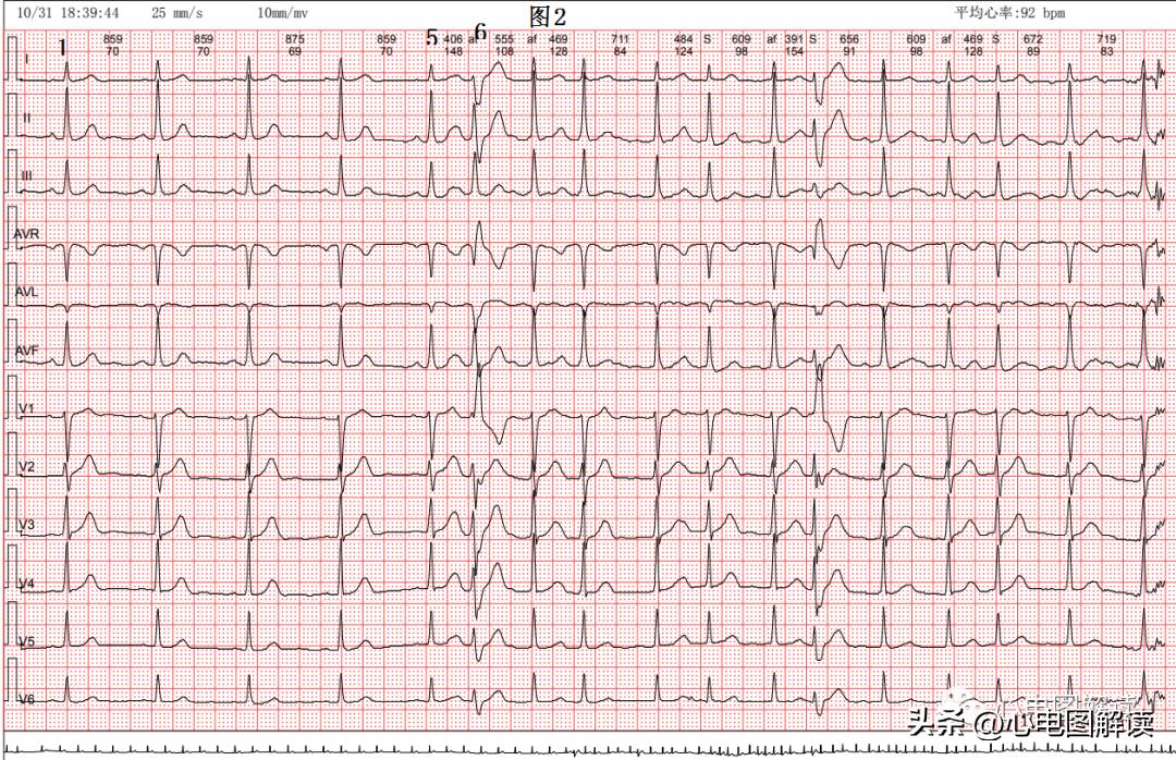 房性早搏和房颤会同时存在吗,频发房早会演变成房颤吗