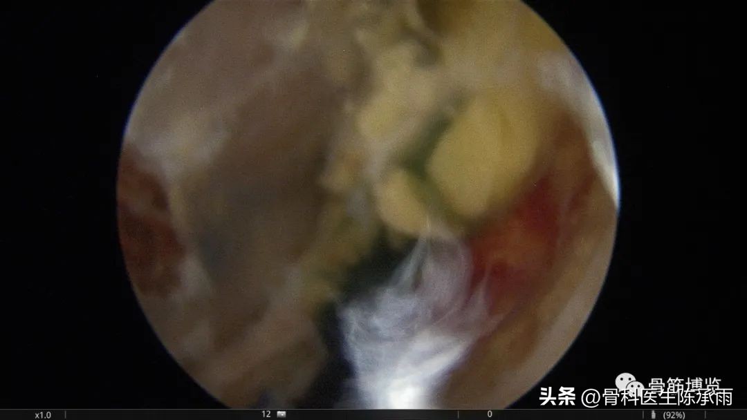 腘窝囊肿关节镜下切除复发,膝关节镜下腘窝囊肿切除的原理
