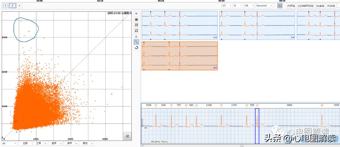 心房颤动伴长间歇心电图,心房颤动伴长间歇是什么意思
