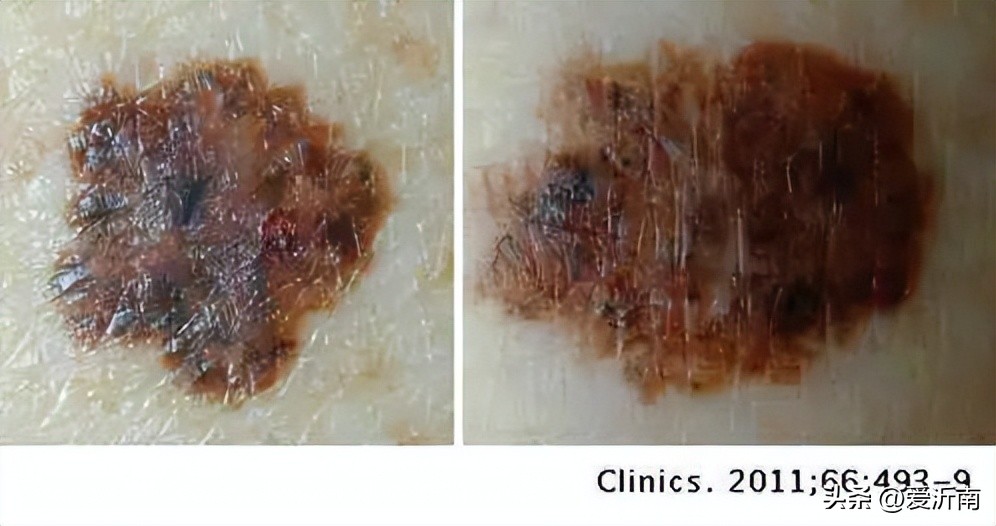 背上长了个肉痣是癌的象征吗,痣越多越容易得癌症