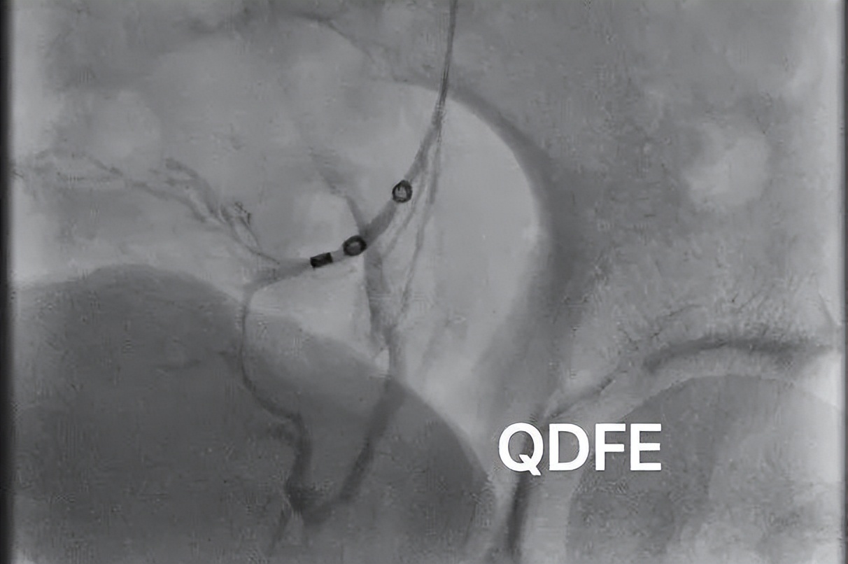 静脉曲张造成的腹痛怎么治,小腹隐隐作痛静脉曲张