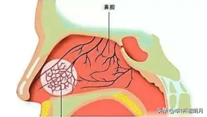 鼻子老是干燥结痂流鼻血怎么回事,鼻黏膜干容易流鼻血怎么办