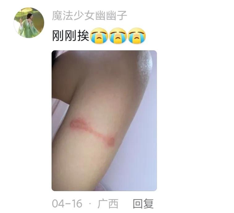 被隐翅虫毁容会好吗,隐翅虫脸上毁容