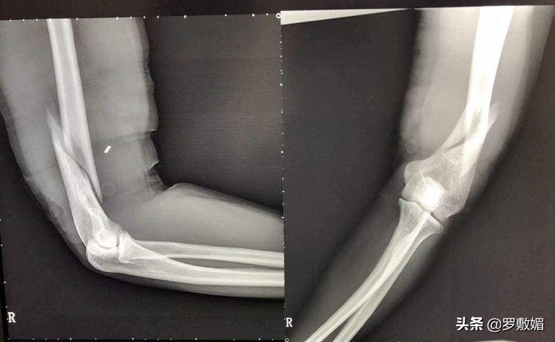 高中生掰手腕粉碎性骨折,高中生掰手腕骨折医疗费谁承担