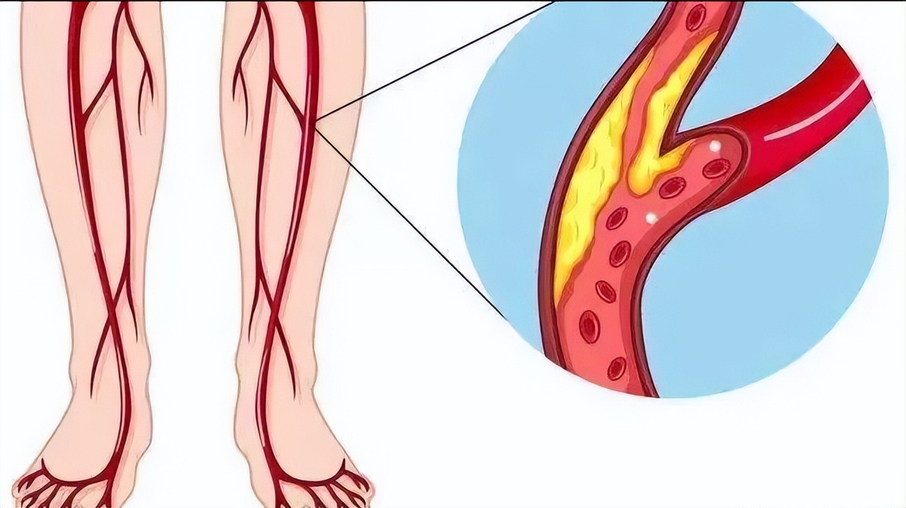 外周血管介入的适应症,介入治疗适用于所有疾病吗