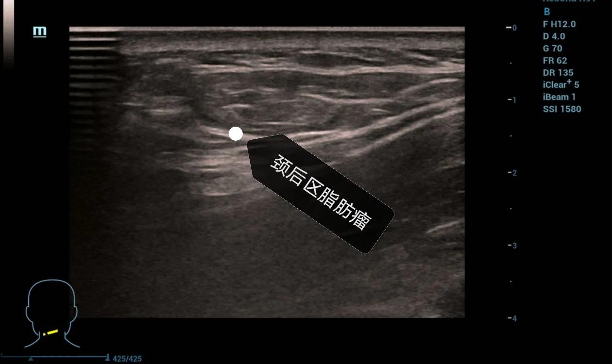 身体腰背部腹部两侧有小硬疙瘩,大腿和腰部起了大片的疙瘩