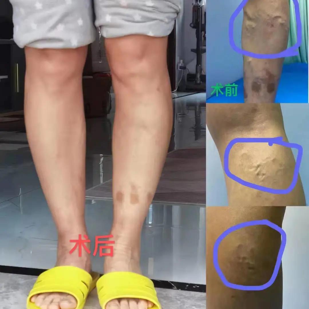 激光治疗下肢静脉曲张,静脉曲张微创和激光哪个好