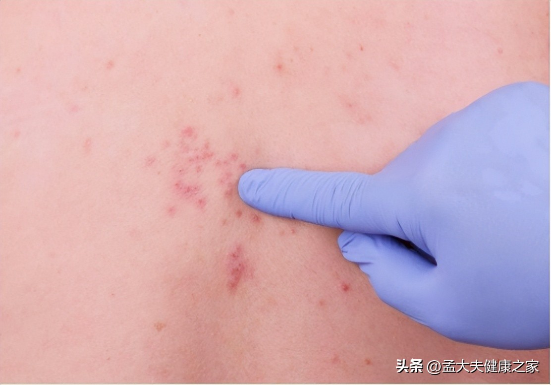 带状疱疹湿疹用什么药好得快,带状疱疹湿疹特效药