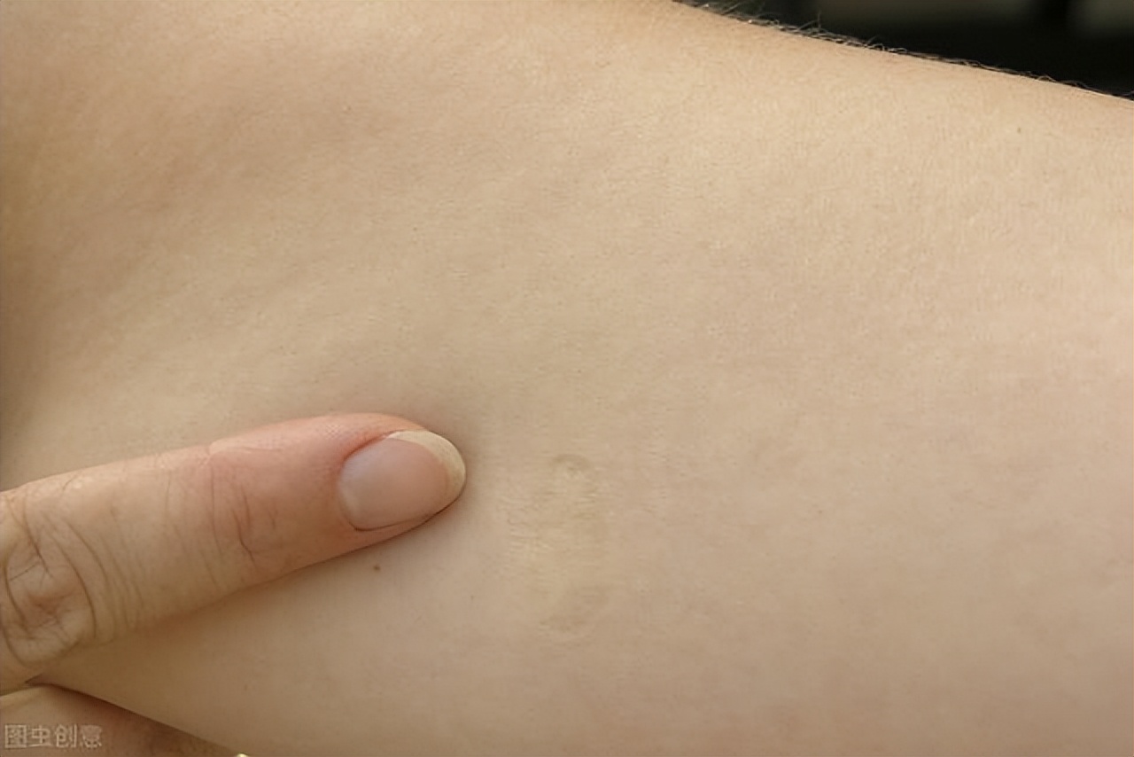 11个国家发现80多例猴痘，中国是否需要补种天花疫苗？