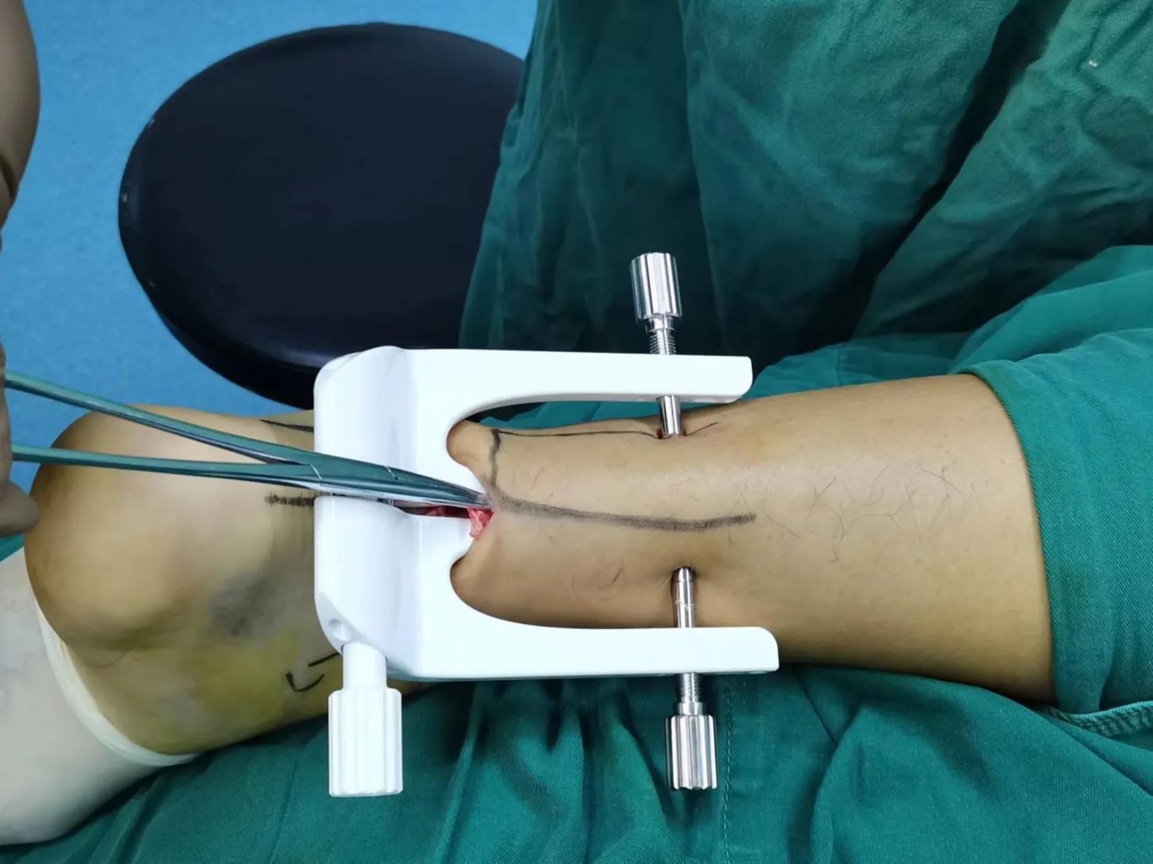 跟腱断裂术后疤痕增生怎么办,跟腱断裂术后跟腱如何愈合