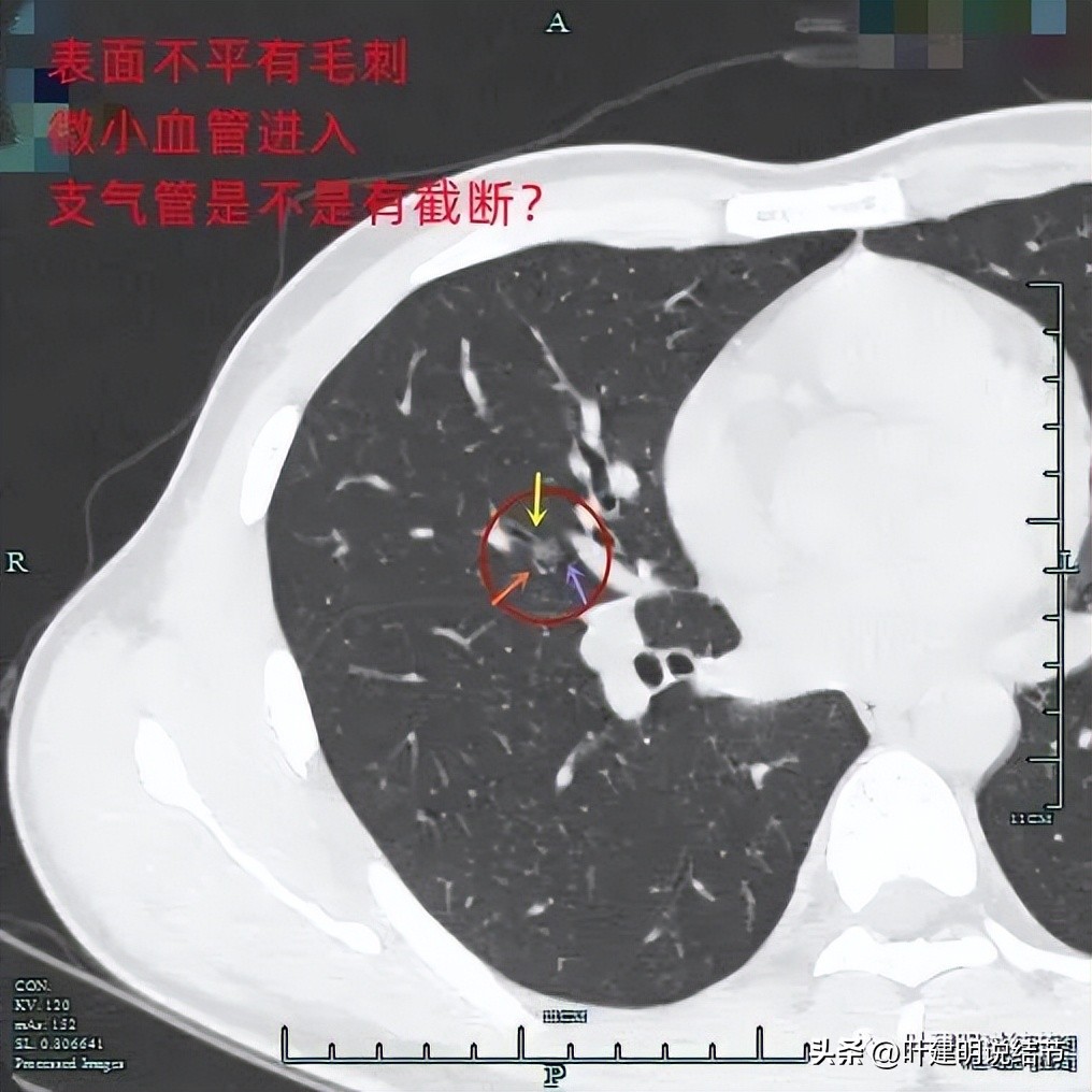 中叶多发微小结节,男性30岁右侧甲状腺单发结节