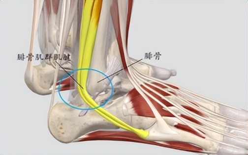 脚踝扭伤腓骨肌腱脱位的症状,踝关节外侧韧带损伤发病原因