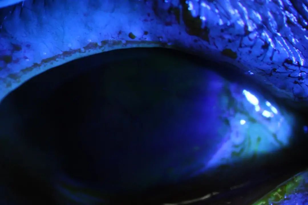 染发后，她“泪流满面”地走进眼科诊室