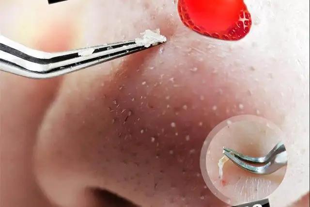 毛孔堵塞毛孔发黑怎样清理,毛孔长螨虫堵塞毛孔怎么办