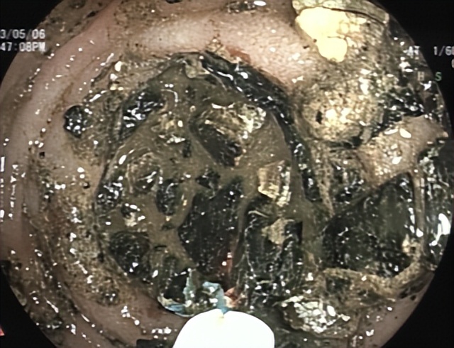 哈医大一院群力院区能体外碎石吗,哈医大一院激光科