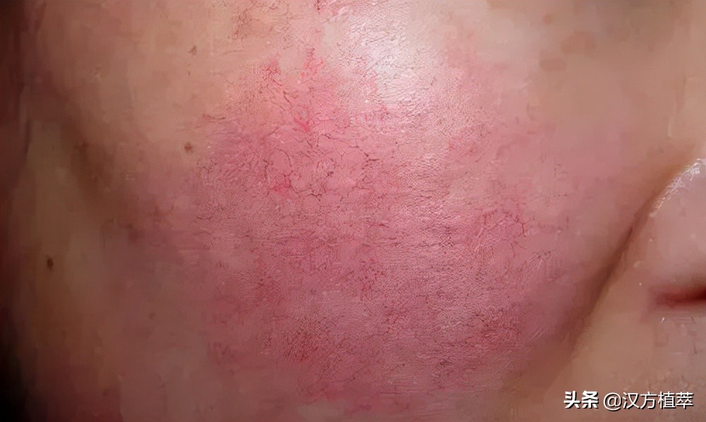 冬天来了皮肤红好痒,冬天来了脸上干燥