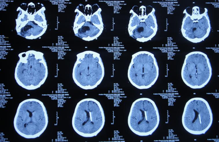 听神经瘤出现脑积水和出血,听神经瘤手术后颅压高症状