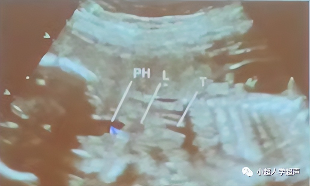 超声影像小视频,食道闭锁超声表现