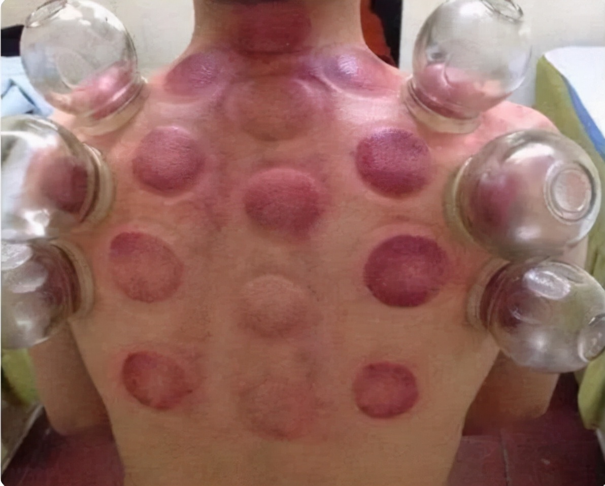 拔火罐时，后背吸出的瘀血，真的是毒素吗？来听听医生的答案