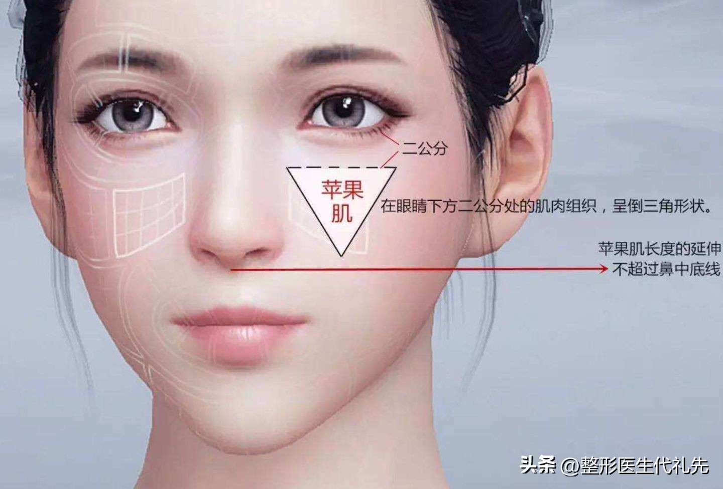 脂肪填充苹果肌刚填充的效果,填充苹果肌用什么填充