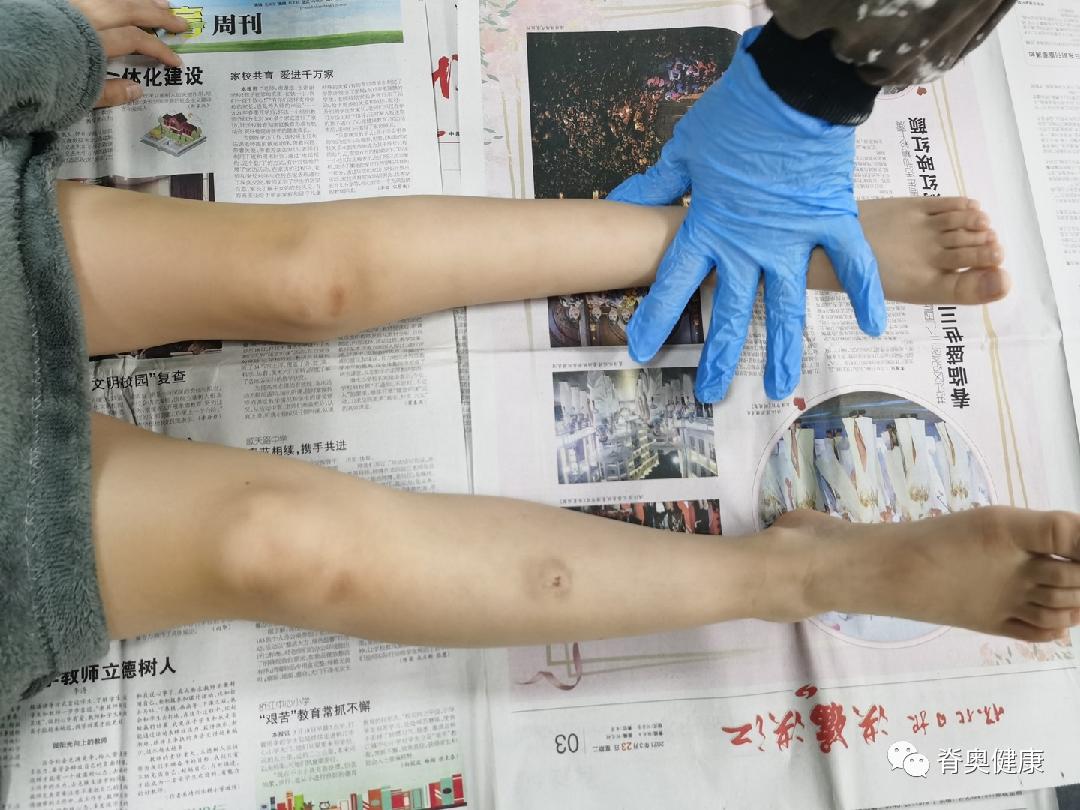 儿童特发性脊柱侧弯康复训练,儿童脊柱畸形矫形