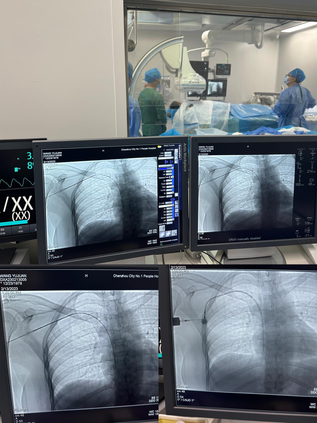 为患者筑造安心“港湾”——肿瘤微创介入诊疗中心成功在DSA引导下实施“输液港植入术”