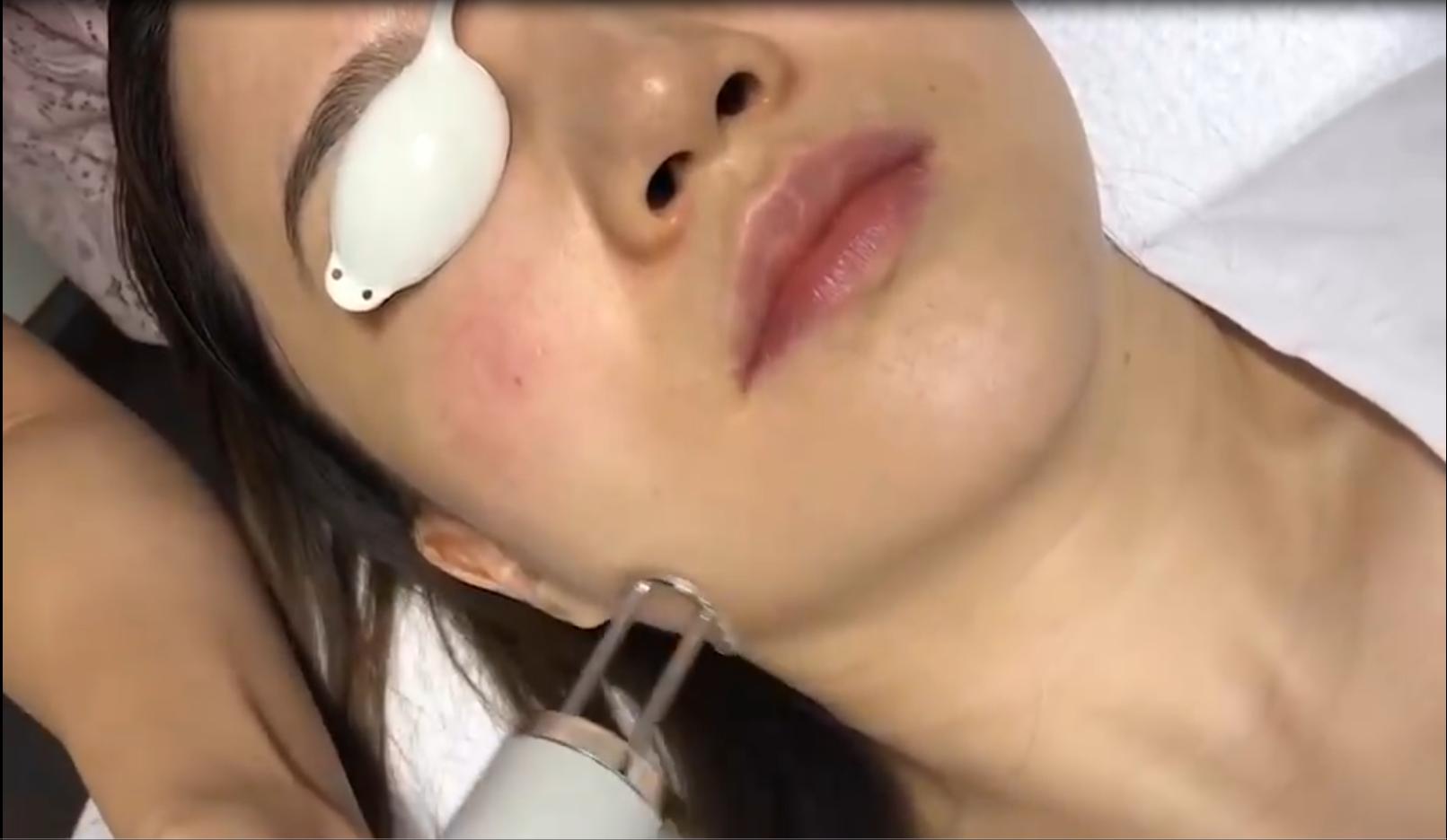 光子嫩肤怎么拍照,光子嫩肤做完后的效果图