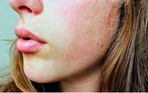 痘痘敏感肌脸起皮痒怎么办,油敏肌皮肤泛红刺痛时用什么