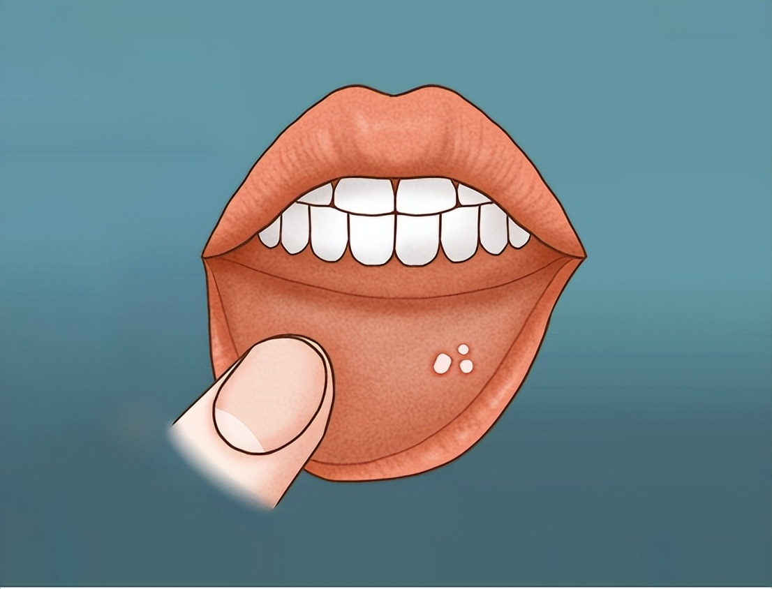 小儿口疮怎么治好得快,舌头上频繁长口疮是怎么回事