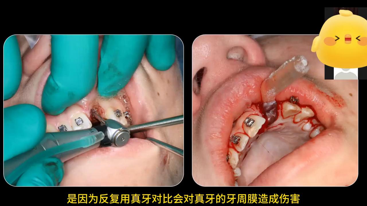 真实种牙视频全过程,种牙后悔的真实案例分析