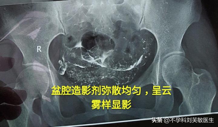 输卵管造影怎么看片子图解,最新的输卵管造影方法