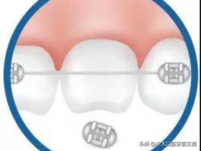 正畸的托槽总是掉怎么办,正畸完发现牙根有坑
